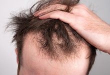 पुरुषों में बालों के झड़ने पर नई जानकारी मिली