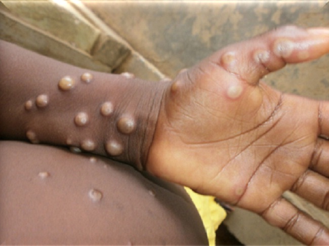 कांगो के कई इलाकों में फैला एमपॉक्स वायरस